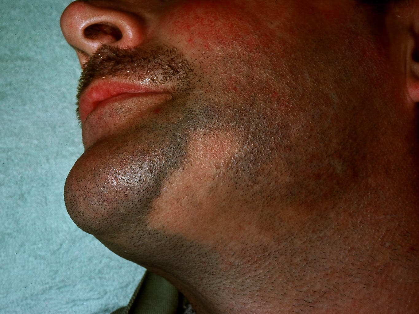 Patchy alopecia areata (beard).