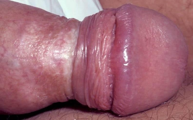 Figure 2 Male genital lichen sclerosus. Redness of the penile head and foreskin. Tight band of scarring on the foreskin leading to an 'hourglass' appearance.