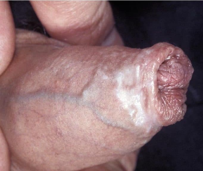 Figure 4 Male genital lichen sclerosus. Tight, band-like, scarring that causes inability to retract the foreskin (phimosis).