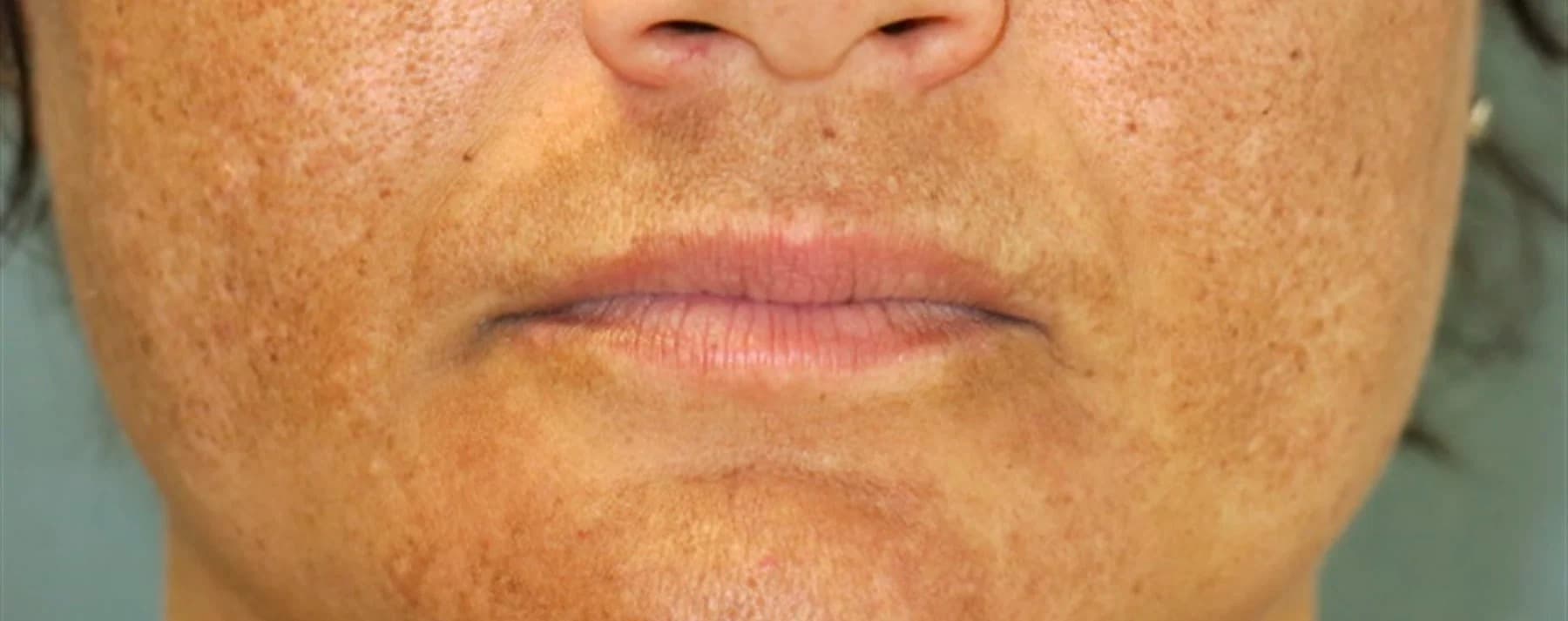 Melasma