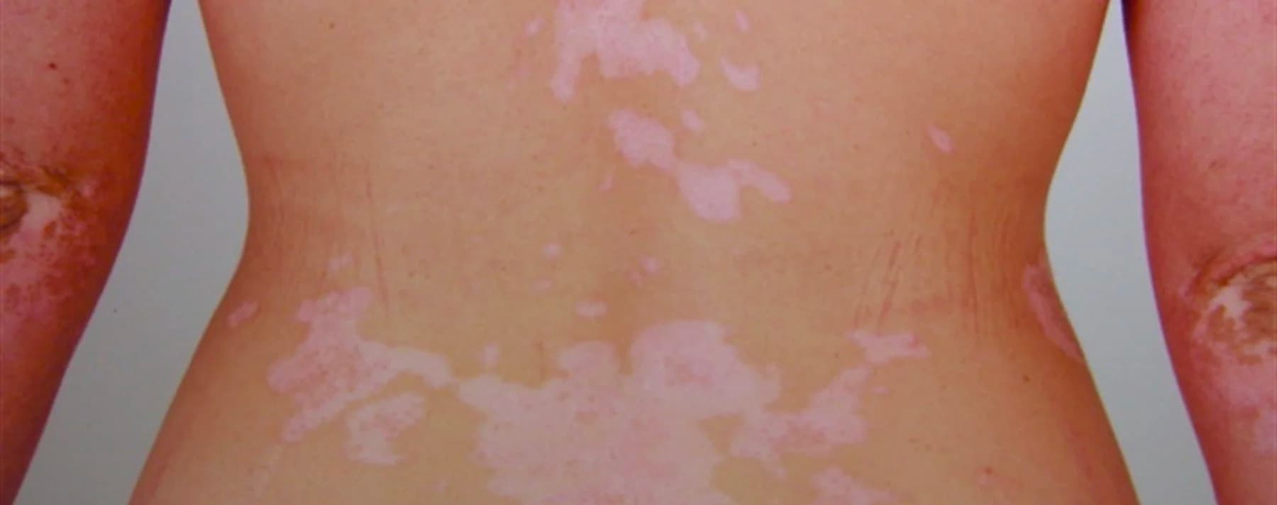 Vitiligo