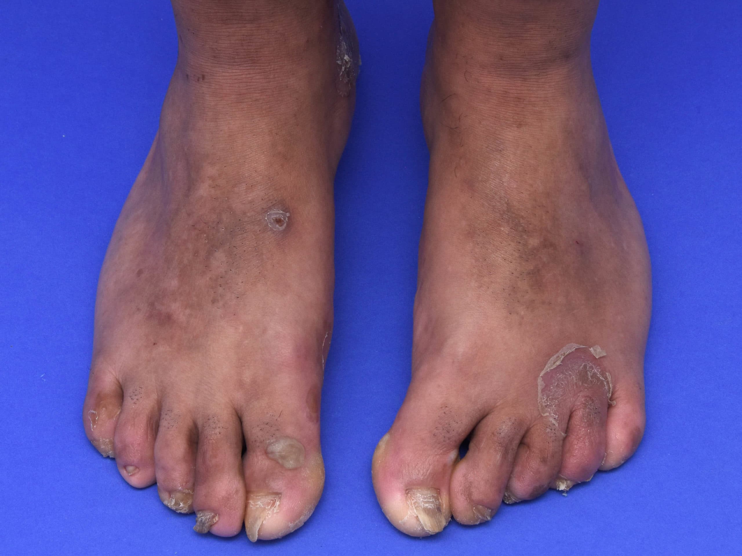 Epidermolysis Bullosa Simplex