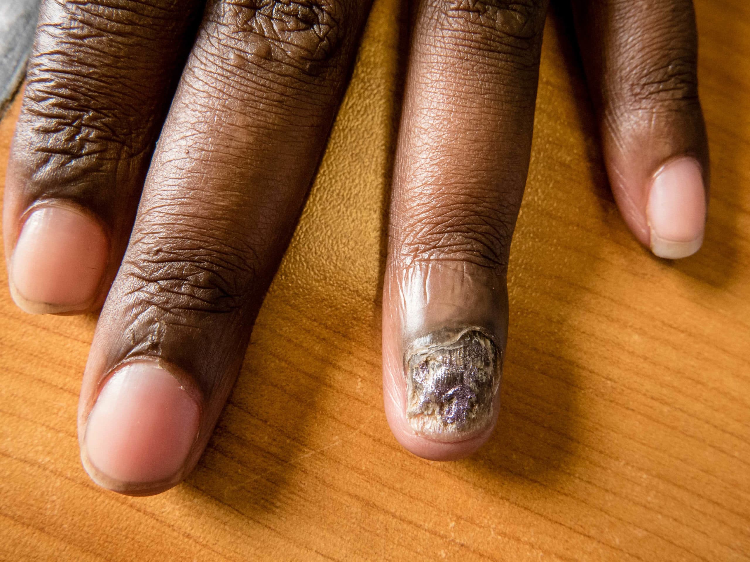 Fungal infection of the nail