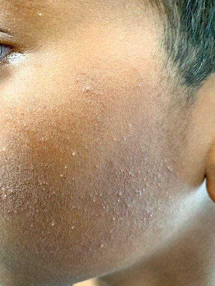Keratosis Pilaris on a child