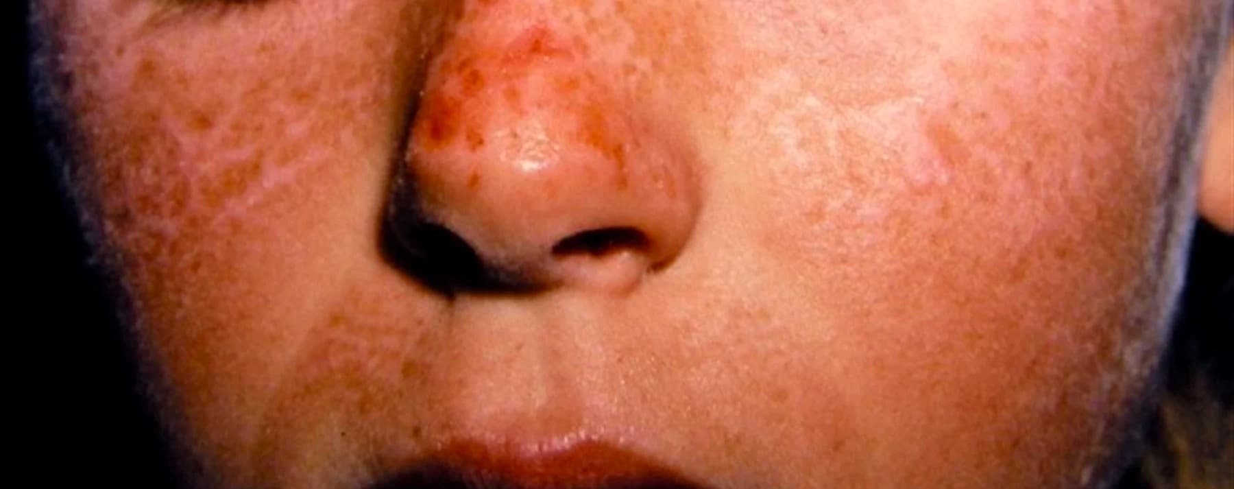 Erythropoietic Protoporphyria & X-Linked Dominant Protoporphyria