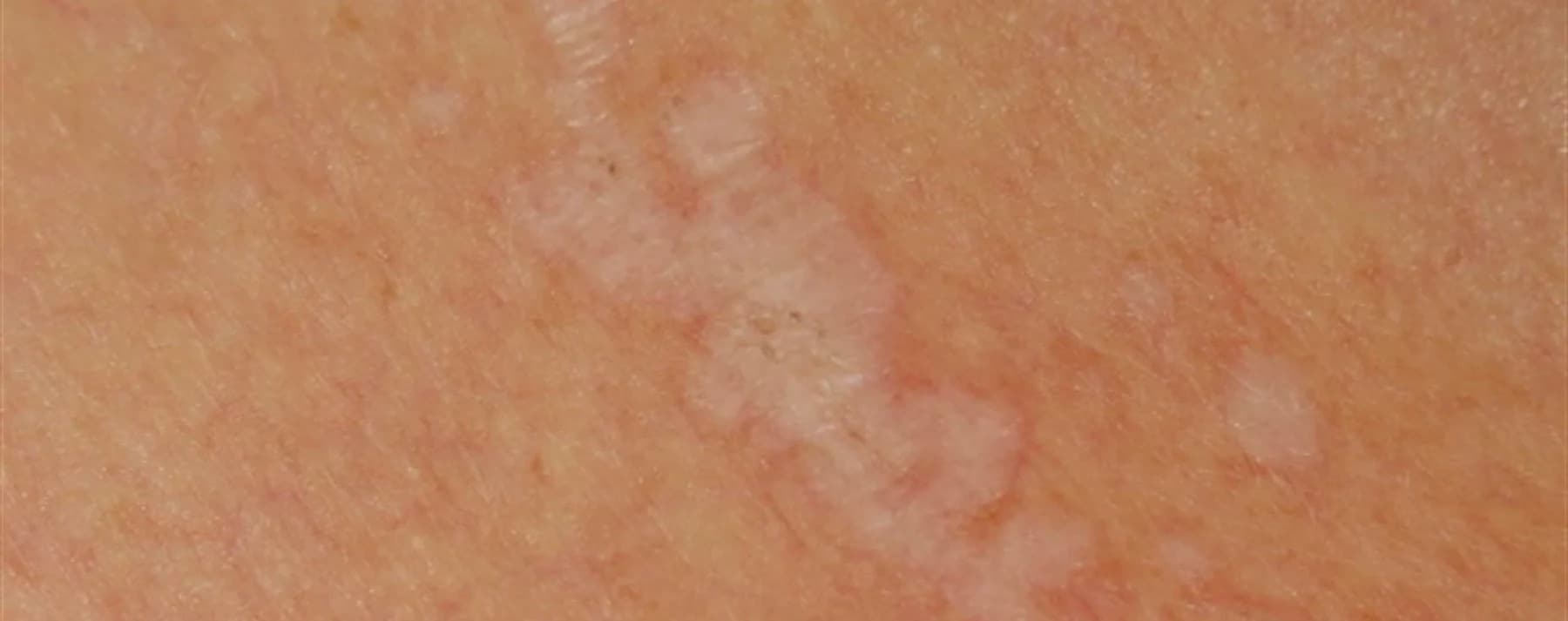 Lichen Sclerosus (in females)