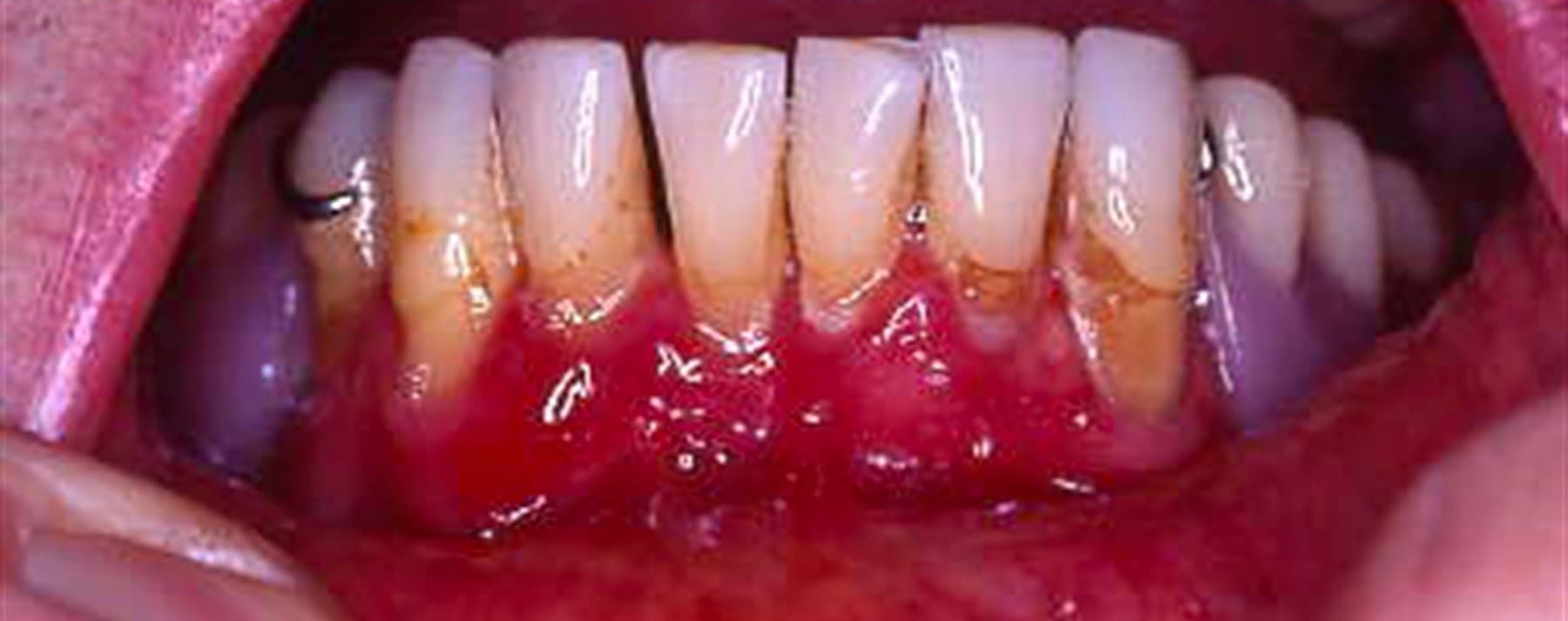 Mucous Membrane Pemphigoid