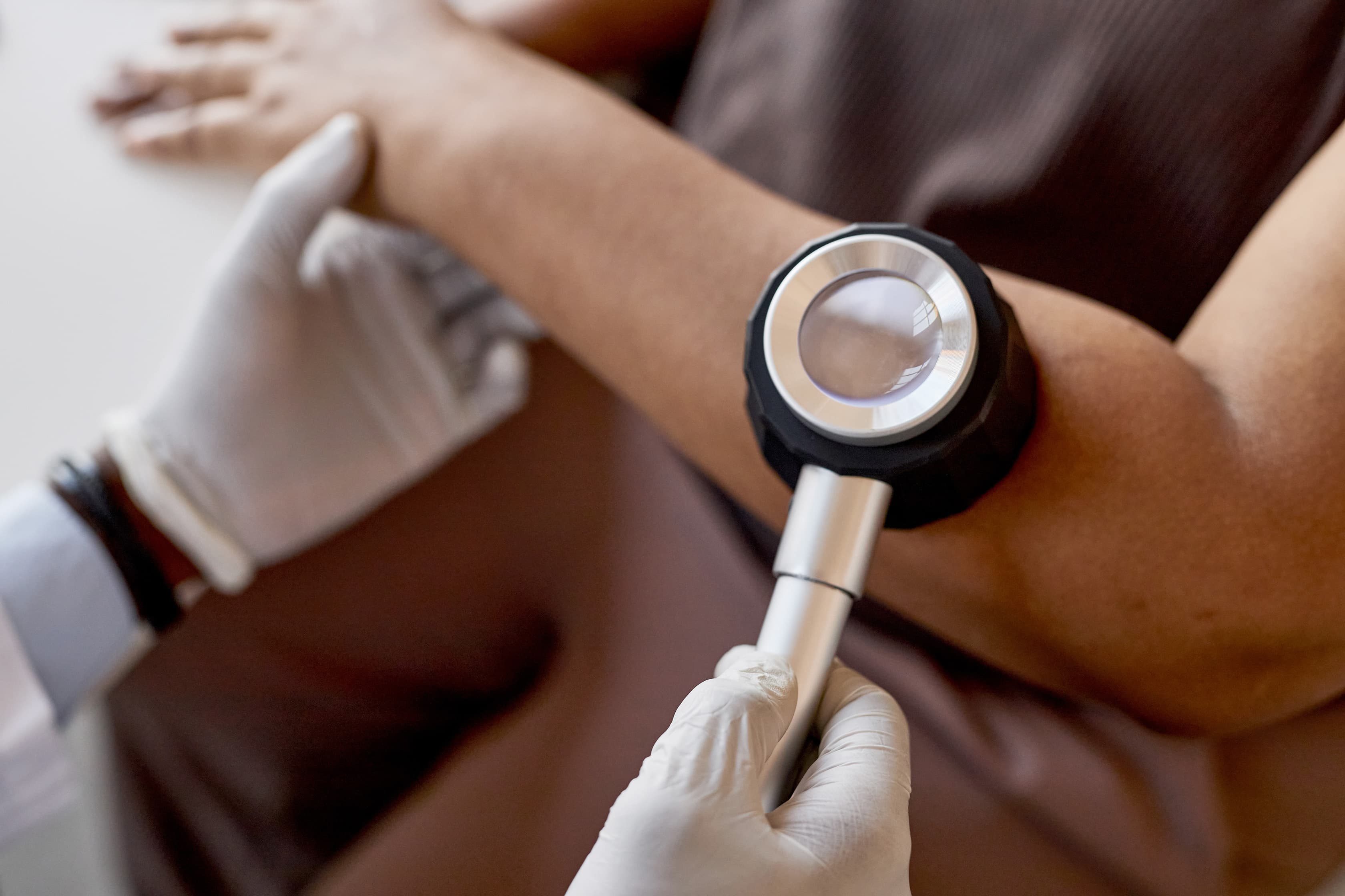 Medical professional wearing gloves examining a patient’s arm with a magnifying dermatology tool, focusing on skin health assessment.