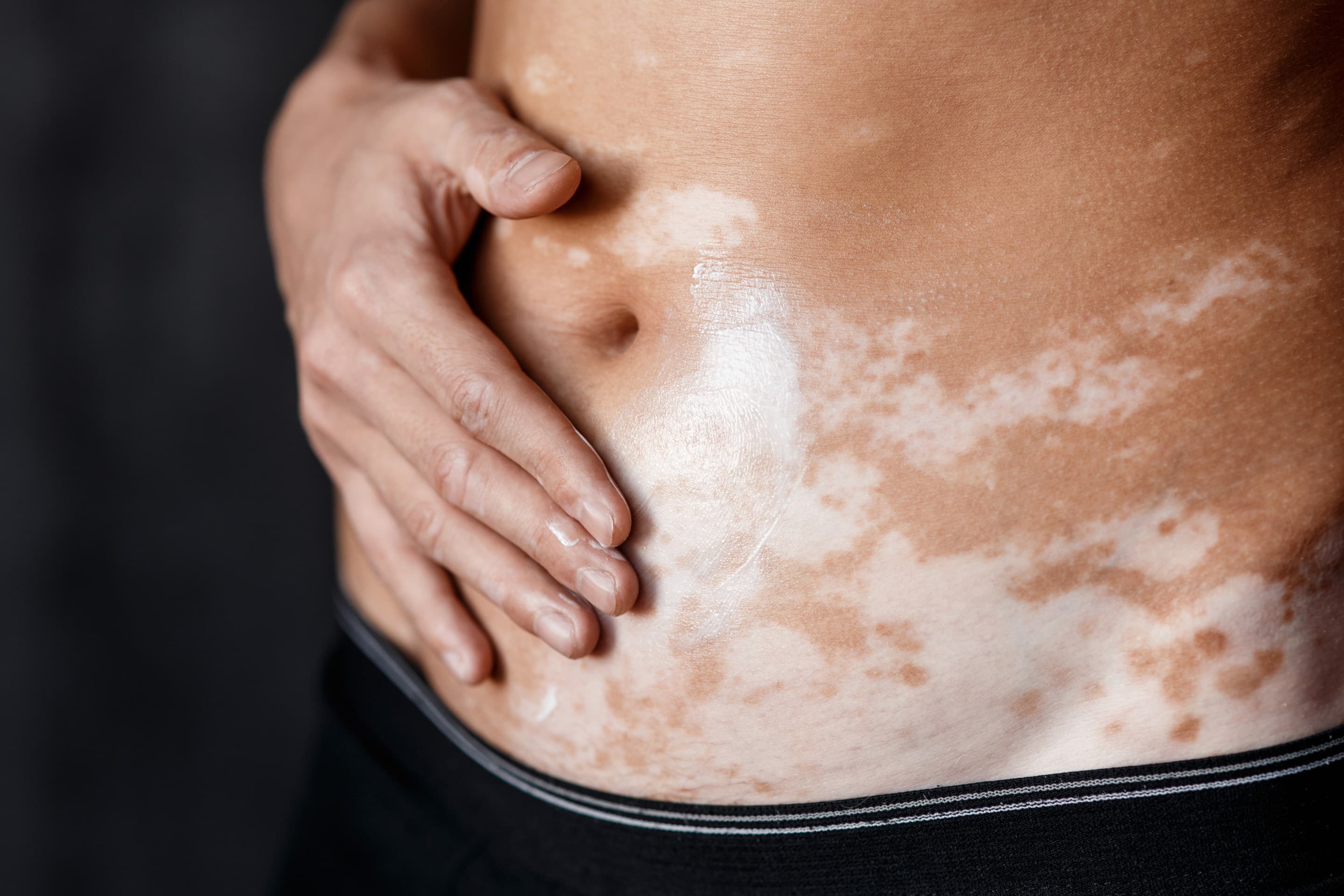 Close-up of vitiligo patches on the abdomen with a hand resting on the skin, showing natural skin pigmentation variation and body diversity.