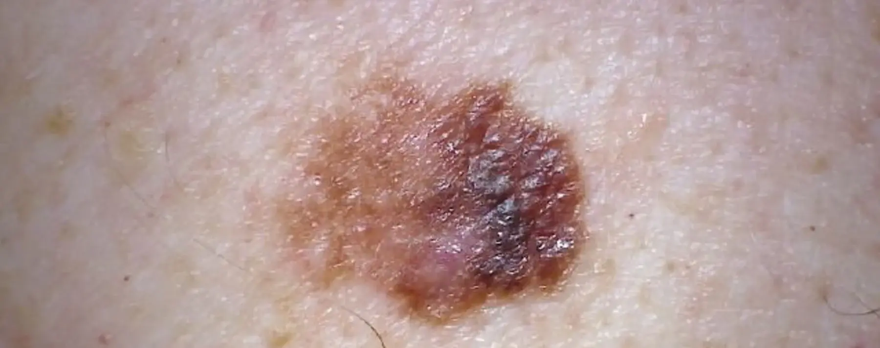 Close up of brown skin cancer mole on skin